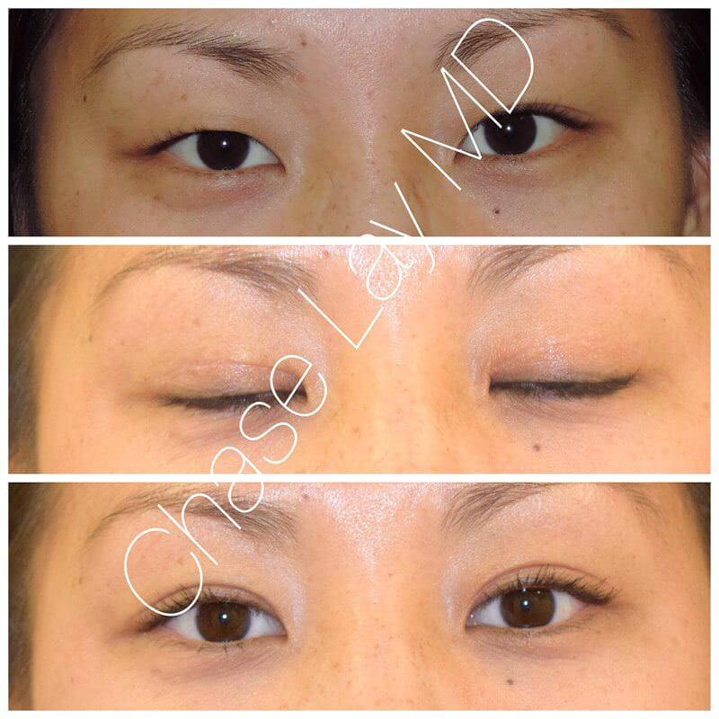 Asian Eyelid Surgery San Jose Double Lid Blepharoplasty San Francisco