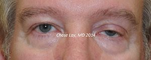 Ptosis Before & After Photos
