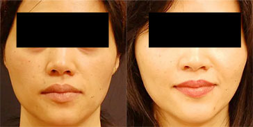 Real patient before and after photo facial plastic surgery