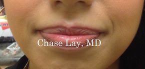 Chin & Lip Implants