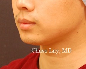 Chin & Lip Implants