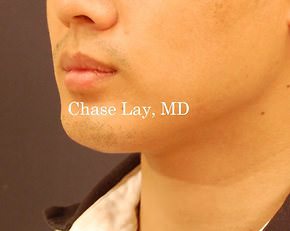 Chin & Lip Implants