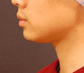 Chin & Lip Implants