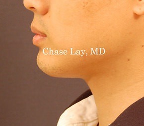 Chin & Lip Implants