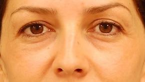 Eyelid Surgery