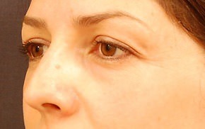 Eyelid Surgery