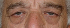 Eyelid Surgery