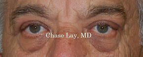 Eyelid Surgery