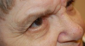 Eyelid Surgery