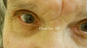 Eyelid Surgery