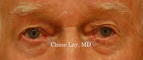 Eyelid Surgery