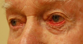 Eyelid Surgery