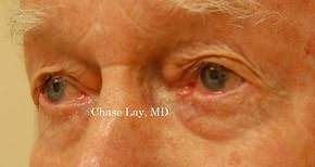 Eyelid Surgery