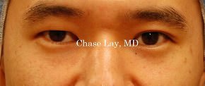 Asian Eyelid Surgery