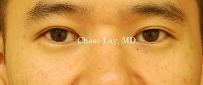 Asian Eyelid Surgery