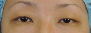 Asian Eyelid Surgery