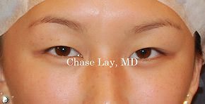 Asian Eyelid Surgery