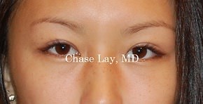 Asian Eyelid Surgery