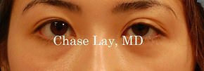 Asian Eyelid Surgery