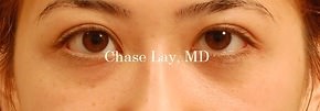 Asian Eyelid Surgery