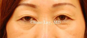 Asian Eyelid Surgery