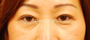 Asian Eyelid Surgery