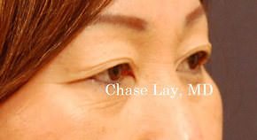 Asian Eyelid Surgery