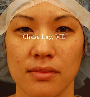 Asian Eyelid Surgery