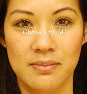 Asian Eyelid Surgery