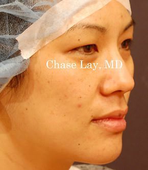 Asian Eyelid Surgery