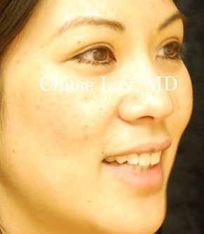 Asian Eyelid Surgery