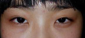 Asian Eyelid Surgery