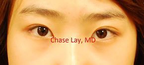 Asian Eyelid Surgery