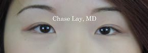 Asian Eyelid Surgery