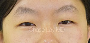 Asian Eyelid Surgery