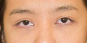 Asian Eyelid Surgery