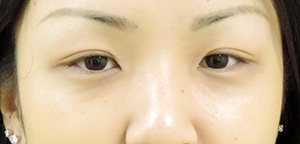 Asian Eyelid Surgery