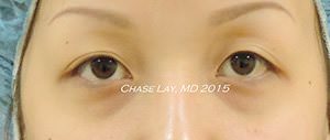 Asian Eyelid Surgery