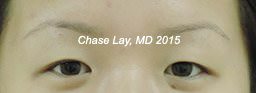 Asian Eyelid Surgery