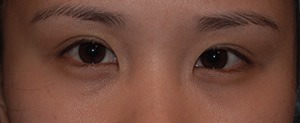 Asian Eyelid Surgery