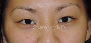 Asian Eyelid Surgery