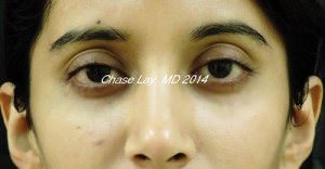 Asian Eyelid Surgery