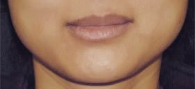 Jaw Reduction