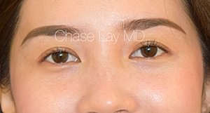 Asian Eyelid Surgery