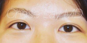 Asian Eyelid Surgery