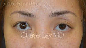 Asian Eyelid Surgery