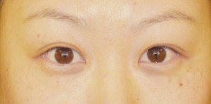 Asian Eyelid Surgery