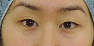 Asian Eyelid Surgery