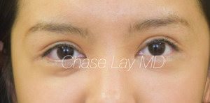 Asian Eyelid Surgery