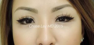 Asian Eyelid Surgery